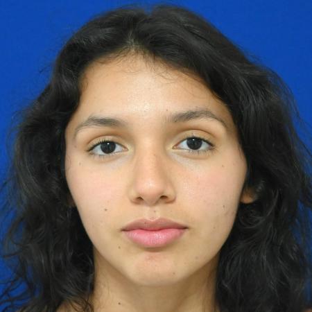 Before image 1 Case #127121 - Case 1 - Rhinoplasty 