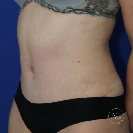 After image 2 Case #127486 - Liposuction and abdominoplasty