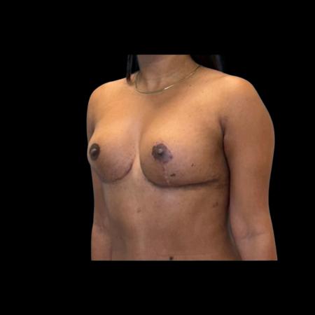 After image 4 Case #126936 - Mastopexy Without Implants 