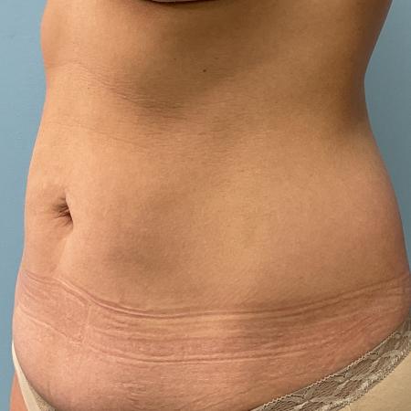 Before image 2 Case #126926 - a 47 year old female; mini tummy tuck w/ lipo 360 