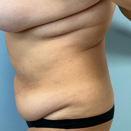 Before image 3 Case #127386 - 35 y.o. female w/ Tummy Tuck & Lipo of flanks 