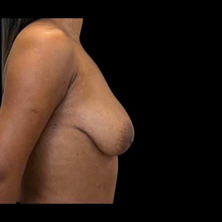 Before image 3 Case #126936 - Mastopexy Without Implants 