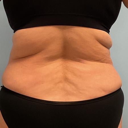 After image 4 Case #127386 - 35 y.o. female w/ Tummy Tuck & Lipo of flanks 
