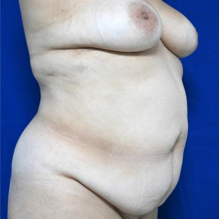 Before image 2 Case #127131 - Case 3 - Lipoabdominoplasty & Breast Implants