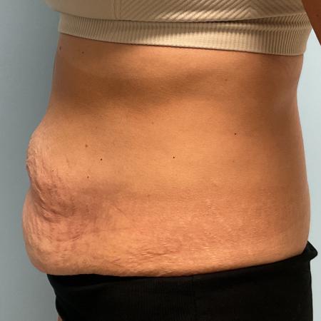 Before image 2 Case #127266 - 43 y.o. female w/ abdominoplasty & lipo of flanks