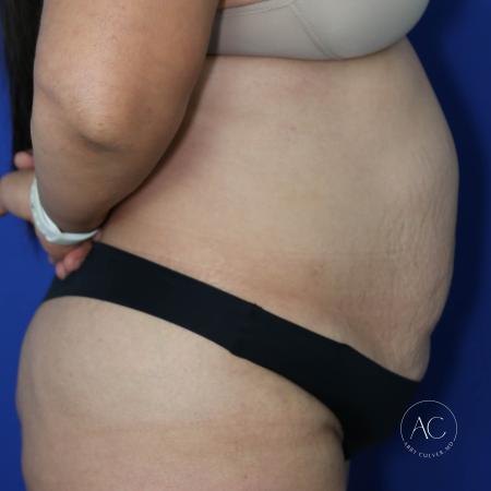 Before image 3 Case #127456 - Circumferential trunk lipo and abdominoplasty