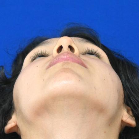 Before image 4 Case #127121 - Case 1 - Rhinoplasty 