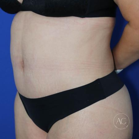 After image 2 Case #127456 - Circumferential trunk lipo and abdominoplasty