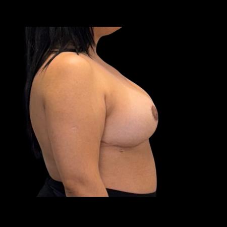 After image 3 Case #126941 - Breast Reduction