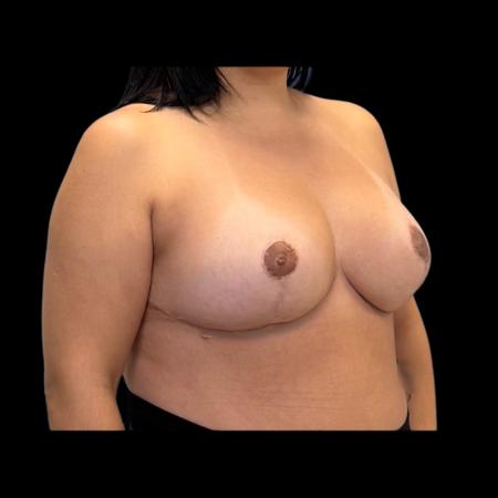 After image 6 Case #126941 - Breast Reduction