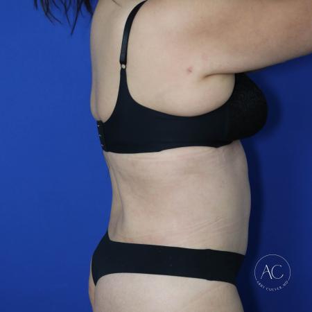 After image 4 Case #127456 - Circumferential trunk lipo and abdominoplasty