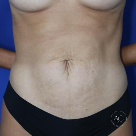 Before image 1 Case #127436 - Abdominoplasty