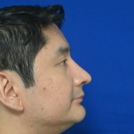 After image 3 Case #127141 - Case 6 - Rhinoplasty