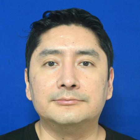 After image 1 Case #127141 - Case 6 - Rhinoplasty