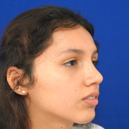 After image 2 Case #127121 - Case 1 - Rhinoplasty 