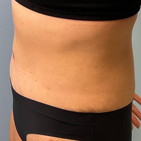 After image 2 Case #127266 - 43 y.o. female w/ abdominoplasty & lipo of flanks