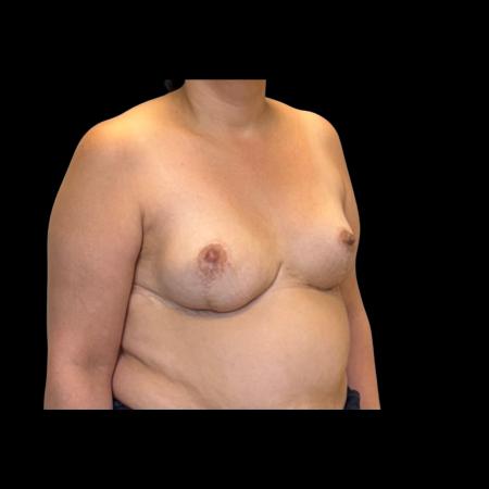 After image 2 Case #126951 - Revision mastopexy
