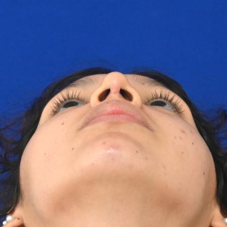 After image 4 Case #127121 - Case 1 - Rhinoplasty 