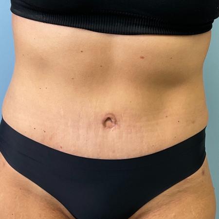 After image 1 Case #127266 - 43 y.o. female w/ abdominoplasty & lipo of flanks