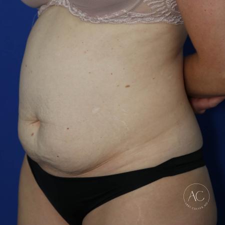 Before image 2 Case #127486 - Liposuction and abdominoplasty