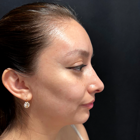 After image 3 Case #127526 - Septoplasty