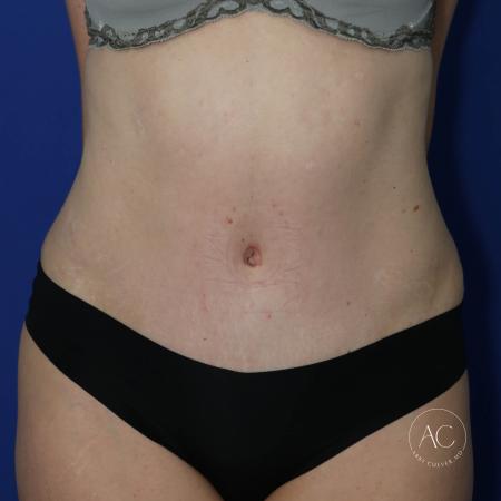 After image 1 Case #127486 - Liposuction and abdominoplasty