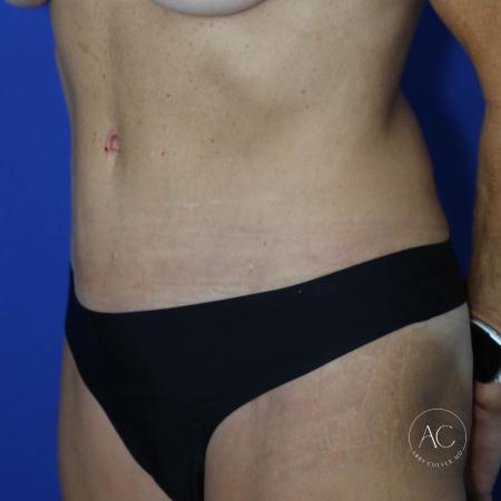 After image 2 Case #127496 - Abdominoplasty