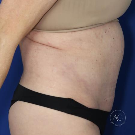 After image 3 Case #127481 - Circumferential trunk lipo and abdominoplasty