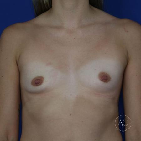 Before image 1 Case #128076 - Breast augmentation