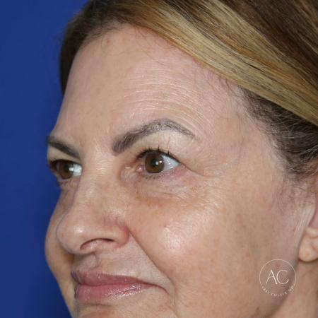 Before image 2 Case #128226 - Upper blepharoplasty and brow lift