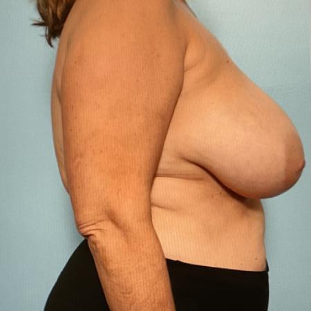 Before image 3 Case #128261 - Breast Reduction