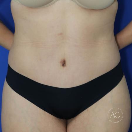 After image 1 Case #128071 - Circumferential trunk lipo/extended abdominoplasty