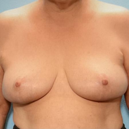 After image 1 Case #128286 - Breast Lifting 
