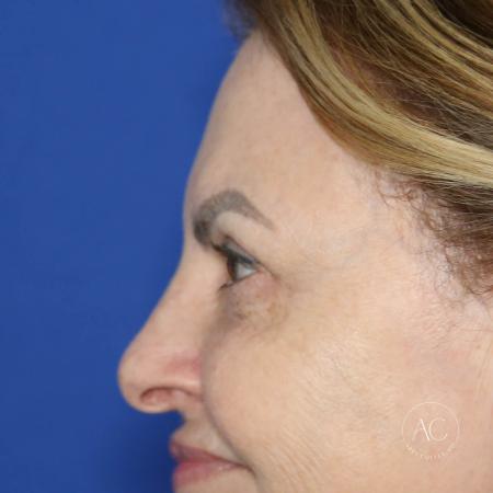 After image 3 Case #128226 - Upper blepharoplasty and brow lift