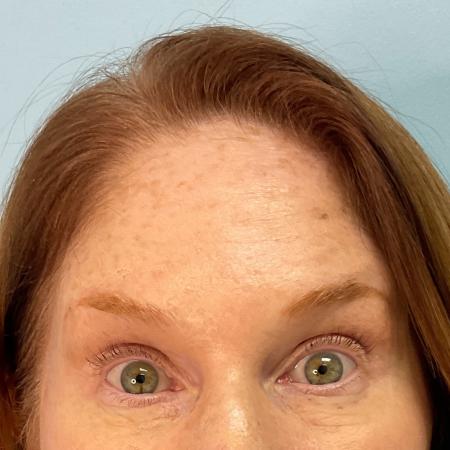 After image 1 Case #127936 - 56 y.o. female with Botox 