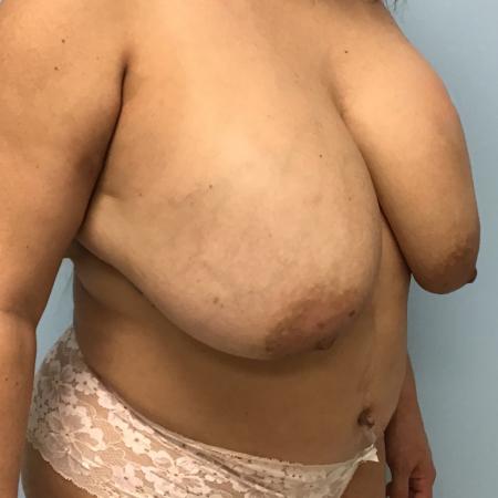 Before image 2 Case #127806 - 48 y.o. Female w/ Breast Revision+ Breast Lift