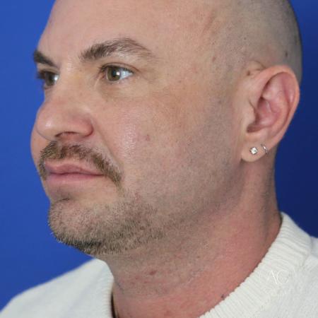 After image 2 Case #128221 - Upper bleph, buccal fat reduction, submental lipo