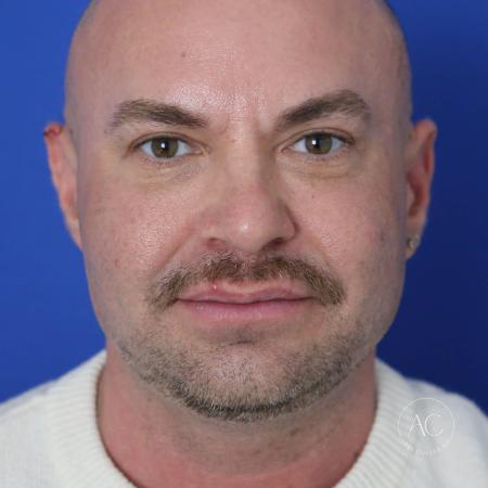 After image 1 Case #128221 - Upper bleph, buccal fat reduction, submental lipo