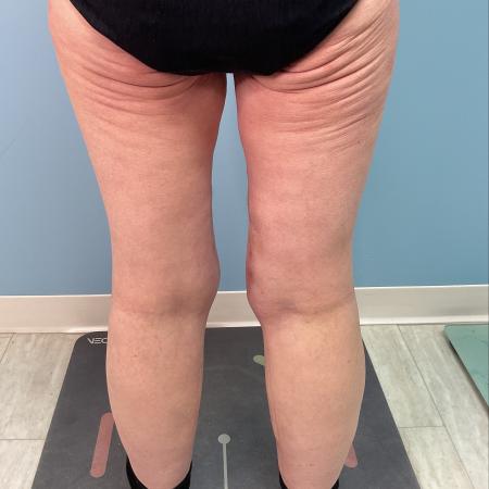 After image 4 Case #128241 - 66 y.o. female w/ Thigh Lift & Lipo Thighs & Calf
