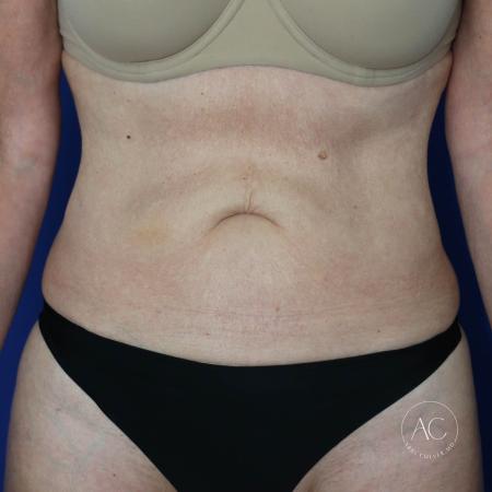 Before image 1 Case #128061 - Abdominoplasty
