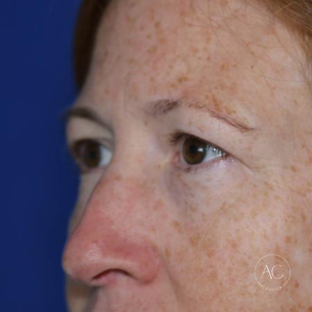 Before image 2 Case #127901 - Upper blepharoplasty