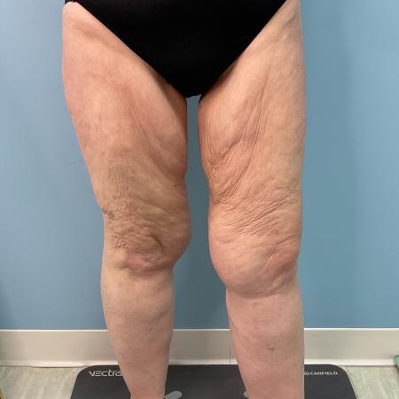 Before image 2 Case #128241 - 66 y.o. female w/ Thigh Lift & Lipo Thighs & Calf