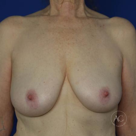 Before image 1 Case #127896 - Breast lift 