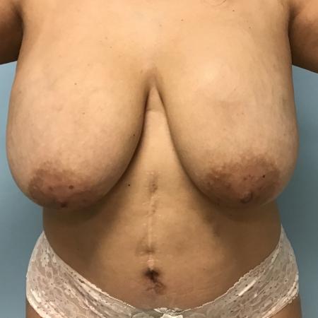 Before image 1 Case #127806 - 48 y.o. Female w/ Breast Revision+ Breast Lift