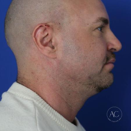 After image 3 Case #128221 - Upper bleph, buccal fat reduction, submental lipo