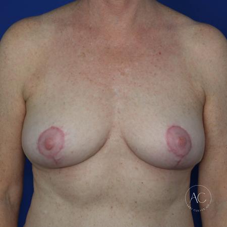 After image 1 Case #127946 - Breast reduction and scar revision