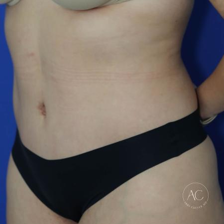 After image 2 Case #128071 - Circumferential trunk lipo/extended abdominoplasty