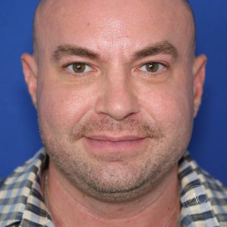 Before image 1 Case #128221 - Upper bleph, buccal fat reduction, submental lipo