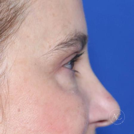 After image 3 Case #127906 - Upper blepharoplasty