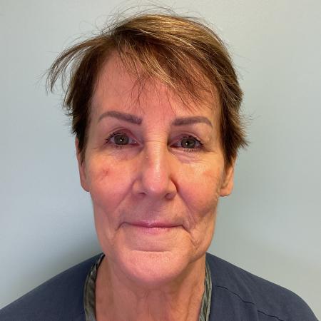 Before image 1 Case #127961 - 69 y.o. w/ Face & Neck Lift, MyEllevate & Renuvion